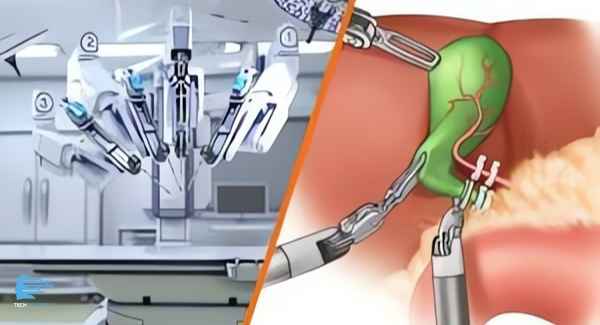 Robotic Gallbladder Removal: Faster Recovery